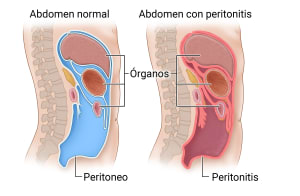 Abdomen normal donde se muestra el peritoneo normal que rodea el abdomen y los órganos. A su lado, se muestra un abdomen con peritonitis, en el que el peritoneo que rodea el abdomen y los órganos está enrojecido e inflamado.