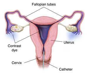Uterus showing catheter inserted through cervix releasing dye into uterus and fallopian tubes.