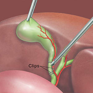 Surgical instrument holding gallbladder while another tool prepares to cut cystic duct below clips.