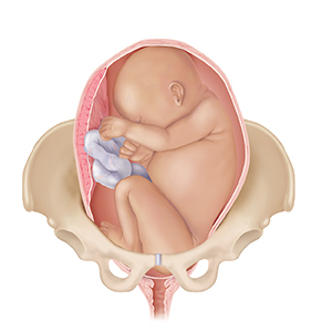 Front view of full-term fetus in uterus between pelvic bones with head up, showing breech position.