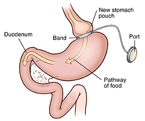 Stomach with adjustable gastric banding and arrows showing path of food.