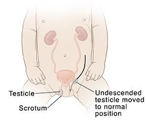 Front view of genitourinary system of baby, showing undescended testicle and where it will be moved to normal position.