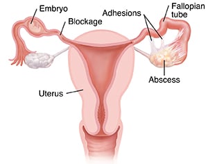 Front view of uterus with complications of pelvic inflammatory disease, such as ectopic pregnancy, adhesions, blockage, and abscess.